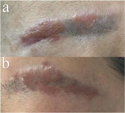 Eyebrow tattoo-associated sarcoidosis: A case report